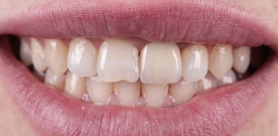 После лечения